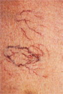 세정맥 확장증 ( Venulectasia )