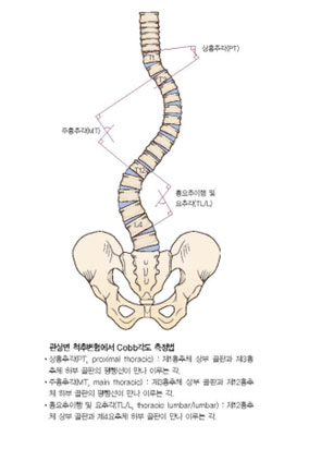 척추 측만증 사진