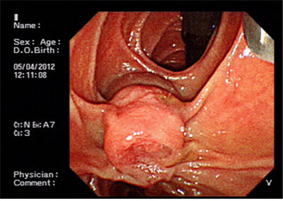 십이지장 유두부 종양 2예