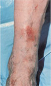 울혈성 피부염(Stasis dermatitis)