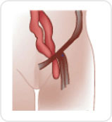 대퇴부 탈장 (femoral hernia)