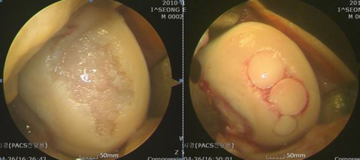 내시경 자가 연골 이식술 사진2
