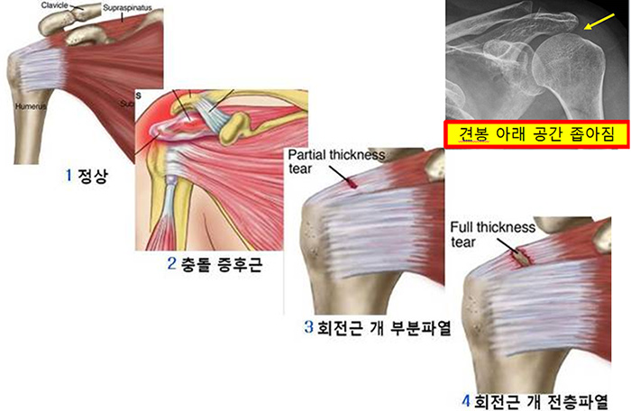 충돌증후군 사진2