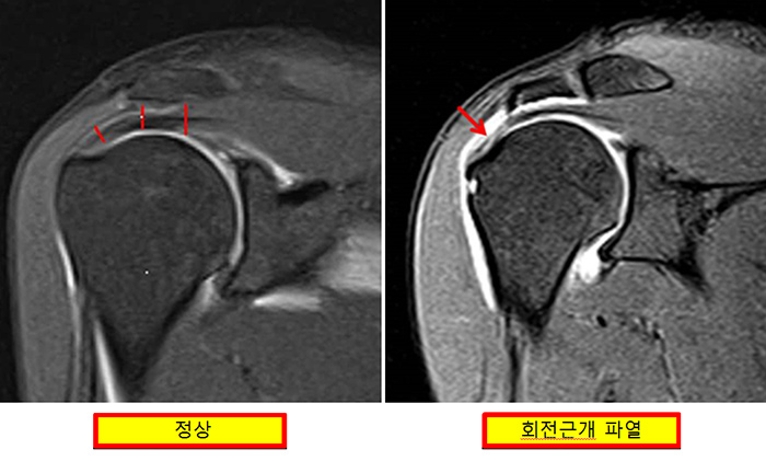 견봉 성형술과 회전근개 건 봉합술 사진