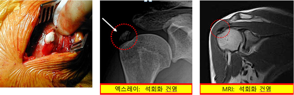 석회화 건염과 관절경적 석회제거술 사진