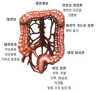 치질이란