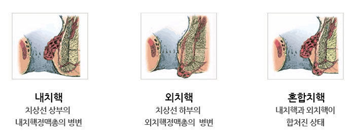 치핵의 종류