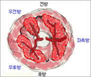 치핵근본수술