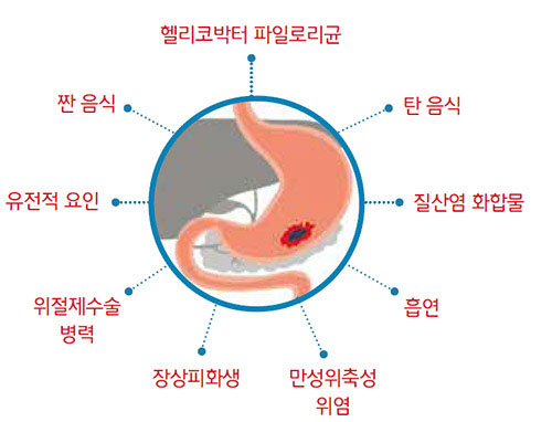 위암의 위험요인